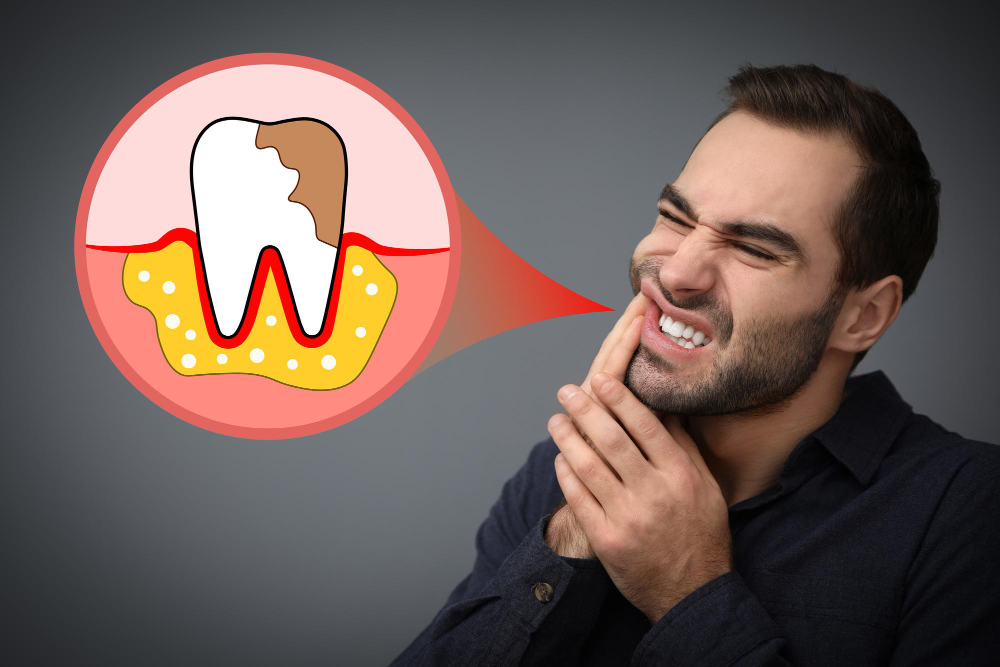 🦷 Silent Saboteurs: How Cavities Develop and What You Can Do About It